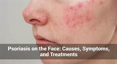 Understanding Psoriasis: Causes, Symptoms & Natural Ways to Support Your Skin.