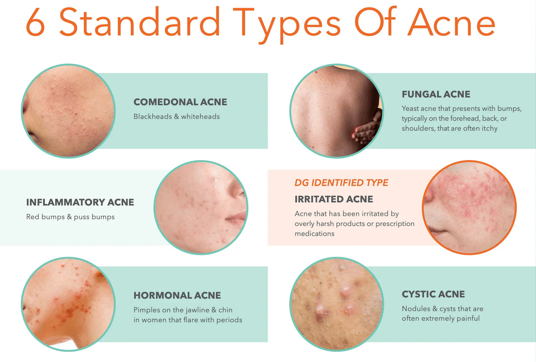Why Your Acne Is Not Going Away Despite Using Products