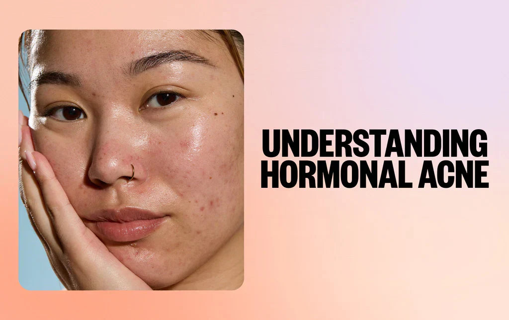 Skincare Tips for Hormonal Acne: What Actually Works