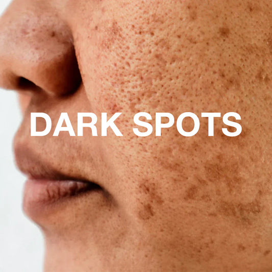 How to Fade Dark Spots Naturally  with Skincare