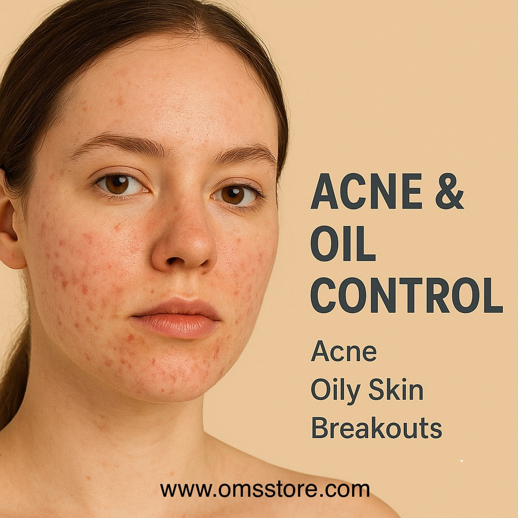 Acne & Oil Control